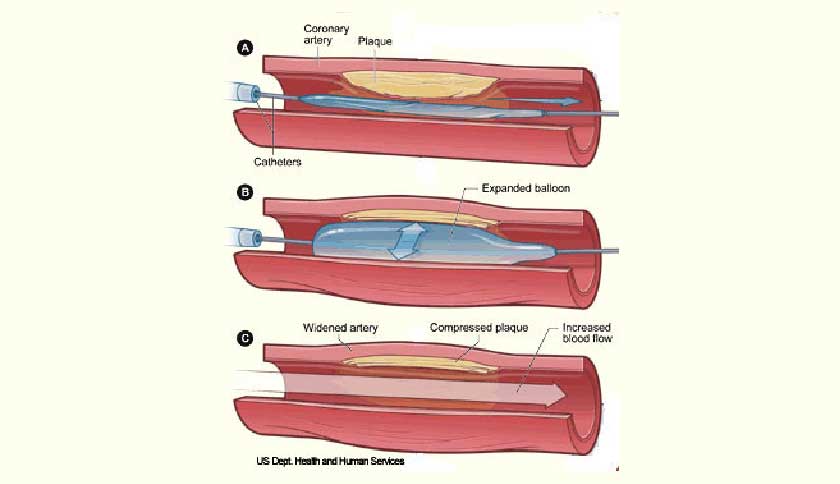 Coronary Angioplasty (PCI)