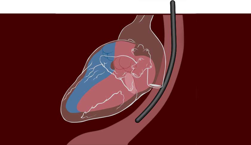 Trans Oesophageal Echocardiogram (TOE)