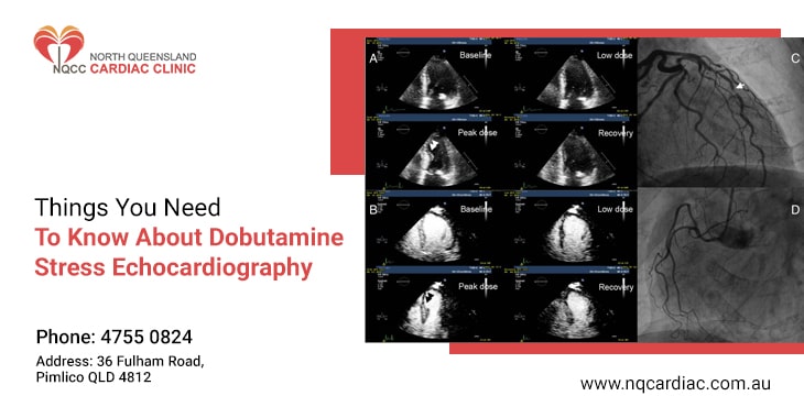 Things You Need To Know About Dobutamine Stress Echocardiography