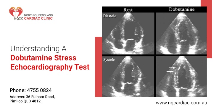 Understanding A Dobutamine Stress Echocardiography Test